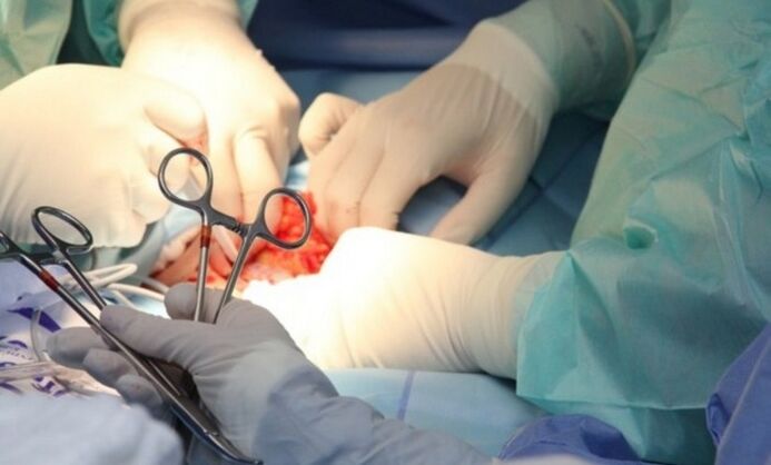 Ligamentotómia – operácia na zväčšenie penisu